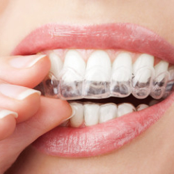 Clareamento Dentário – Estética dental